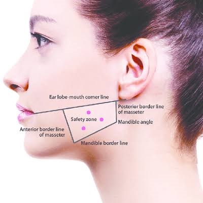 Masseter Botox